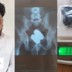 മതിയായ വഴി സൗകര്യമില്ല, ആശുപത്രിയിലെത്താന്‍ പ്രയാസം; അട്ടപ്പാടിയിലെ 8 ആദിവാസി ഊരുകളിൽ സ്ട്രക്ച്ചറുകള്‍ എത്തിച്ച് സുരേഷ് ഗോപി